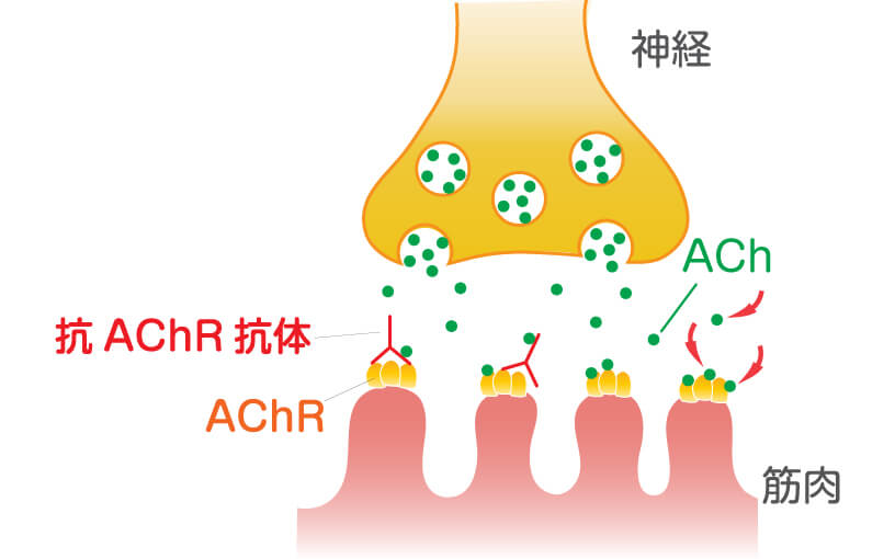 MG Source|抗コリンエステラーゼ薬(飲み薬)