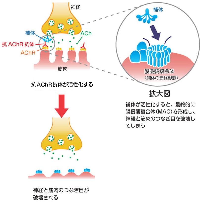 MG Source|補体阻害薬(点滴) MG Source|補体阻害薬(点滴)